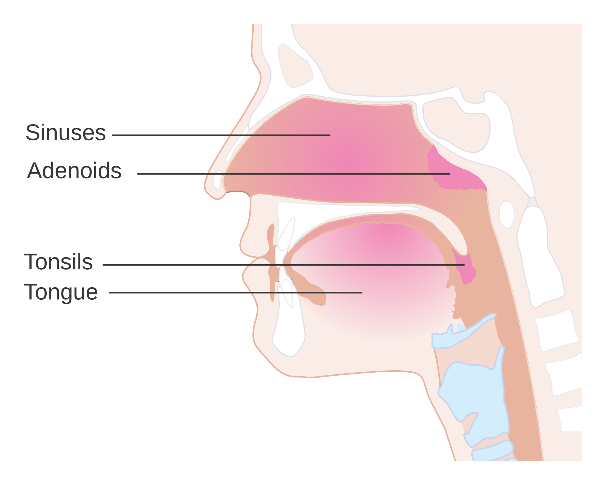 Adenoids